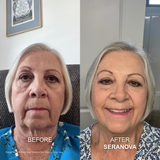 Micro-Infusion Seranova : Peau Neuve