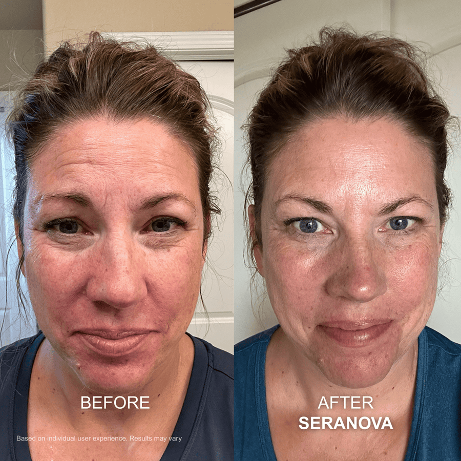 Micro-Infusion Seranova : Peau Neuve