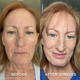 Micro-Infusion Seranova : Peau Neuve